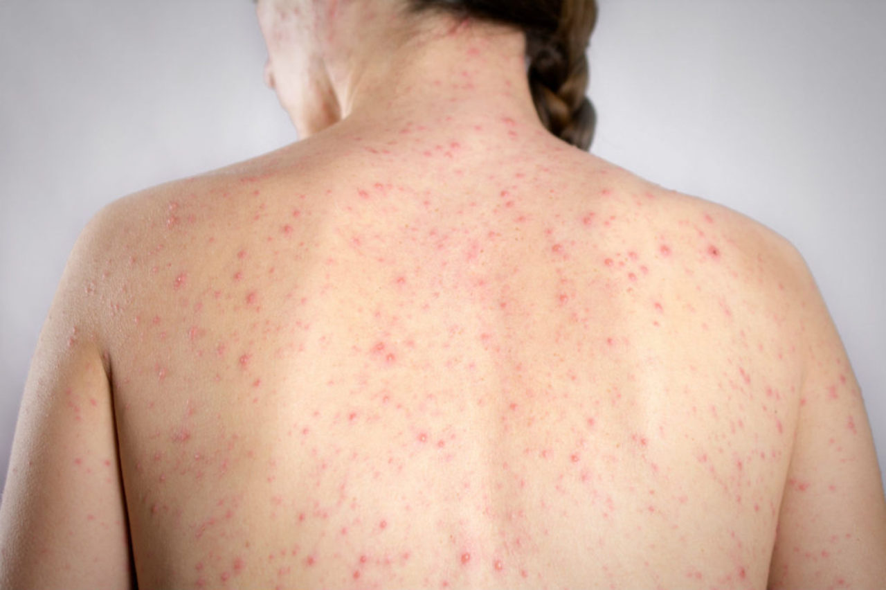 female-back-measles-AdobeStock_198035521