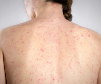 female-back-measles-AdobeStock_198035521