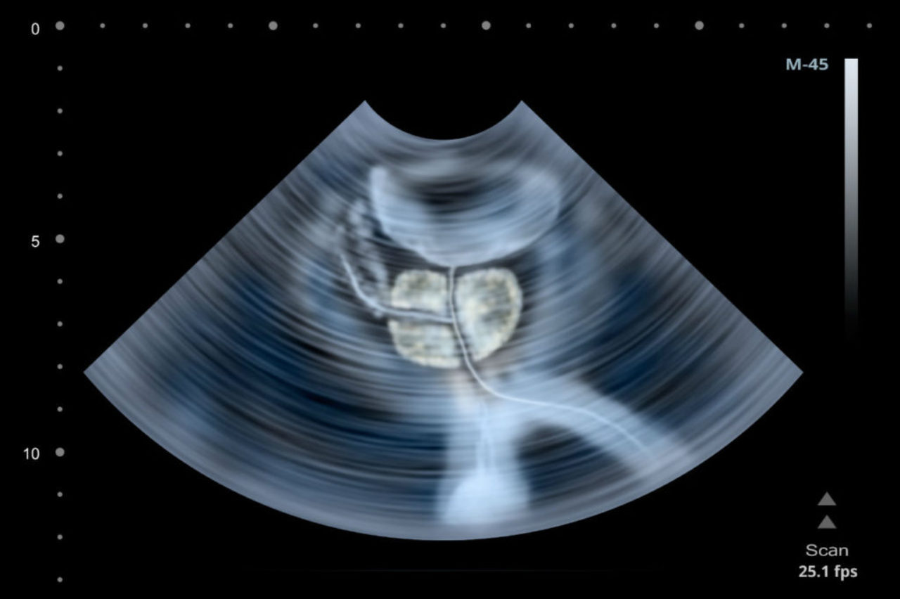 scan-of-male-groin-area-including-prostate