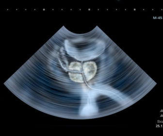 scan-of-male-groin-area-including-prostate