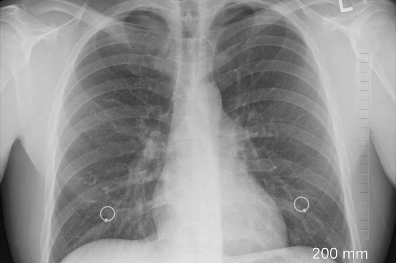 xray-chest-lungs-ribs